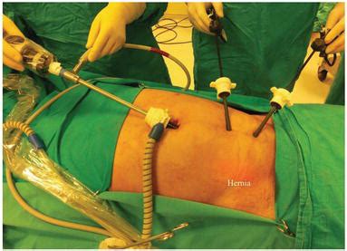 laparoscopic bilateral inguinal hernia repair